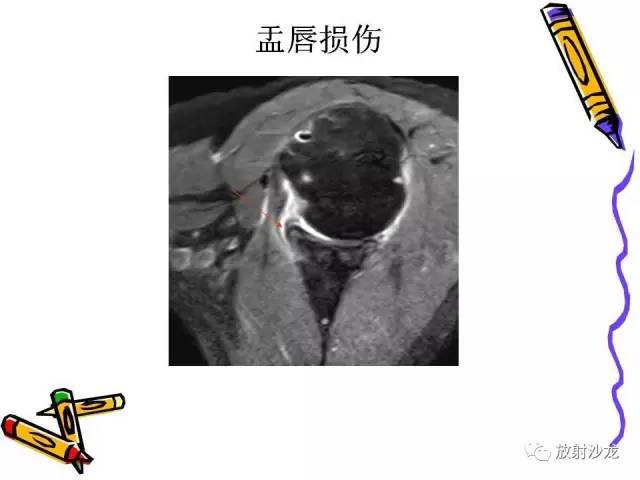 【PPT】肩关节常见创伤性病变