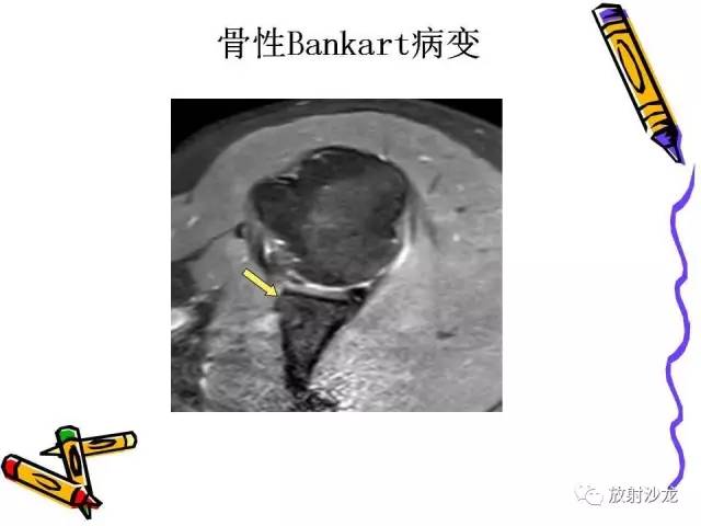 【PPT】肩关节常见创伤性病变