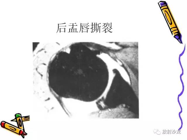 【PPT】肩关节常见创伤性病变