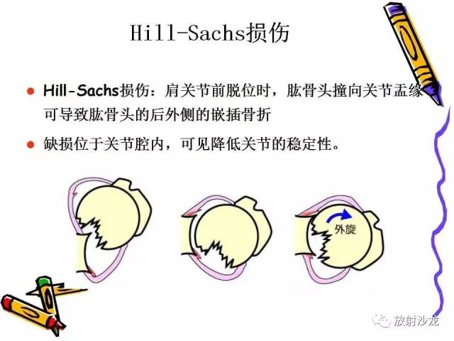 【PPT】肩关节常见创伤性病变