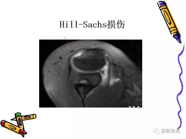 【PPT】肩关节常见创伤性病变