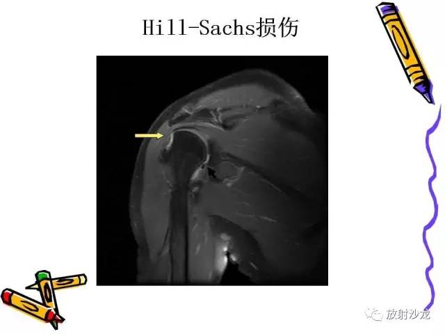 【PPT】肩关节常见创伤性病变