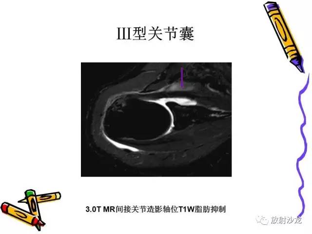 【PPT】肩关节常见创伤性病变