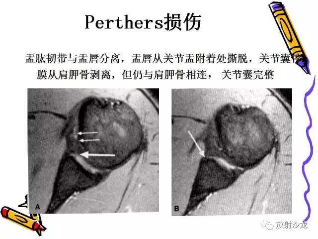 【PPT】肩关节常见创伤性病变