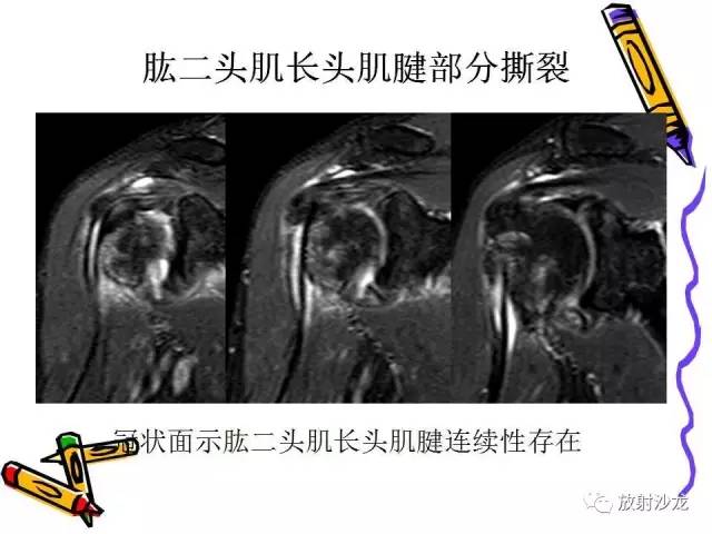 【PPT】肩关节常见创伤性病变