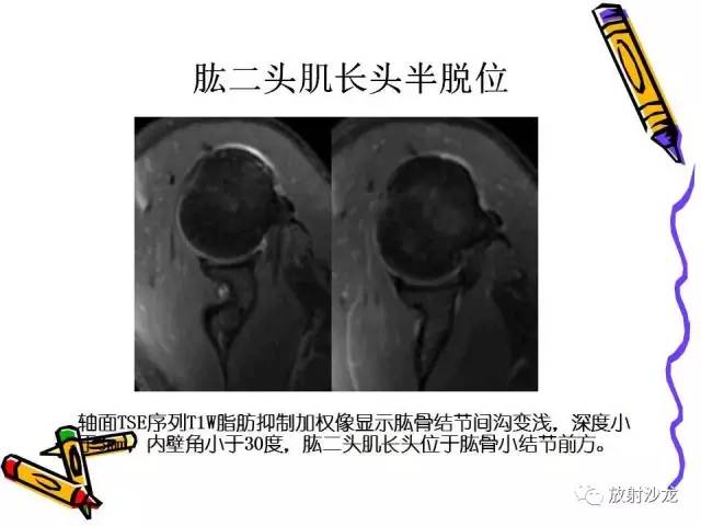 【PPT】肩关节常见创伤性病变