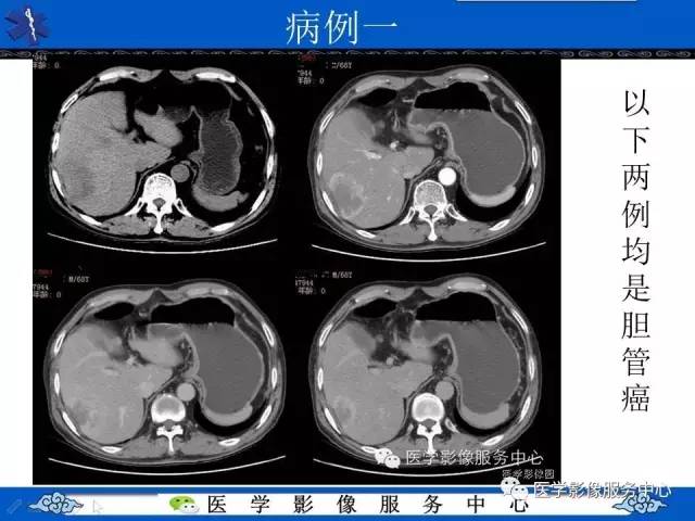 【影像征象】肝包膜凹陷征