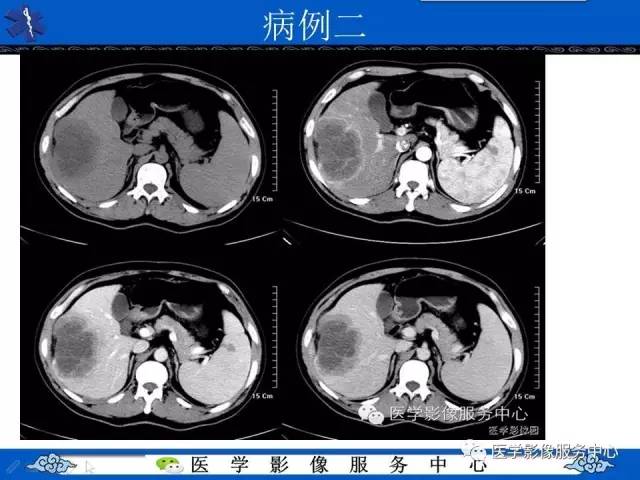 【影像征象】肝包膜凹陷征