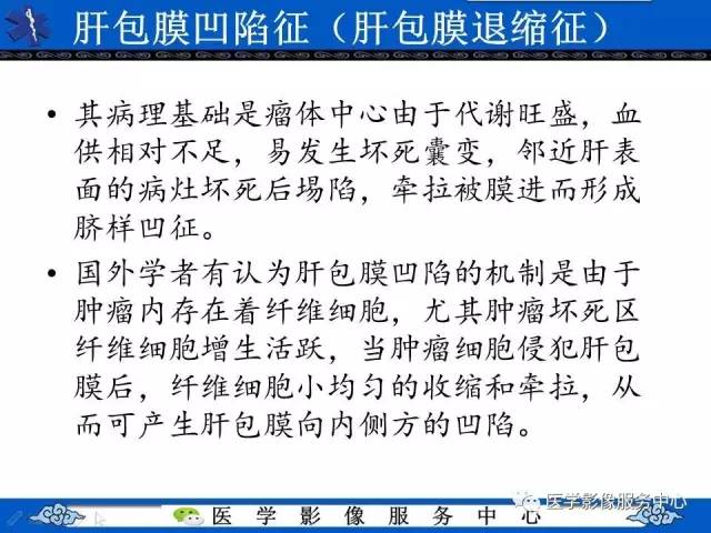 【影像征象】肝包膜凹陷征