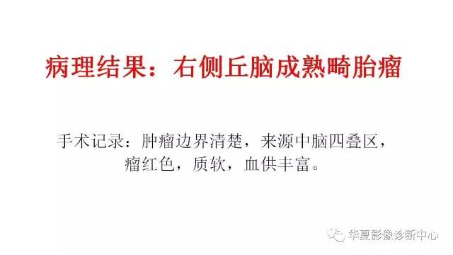 【病例】右侧丘脑畸胎瘤1例CT及MR影像表现