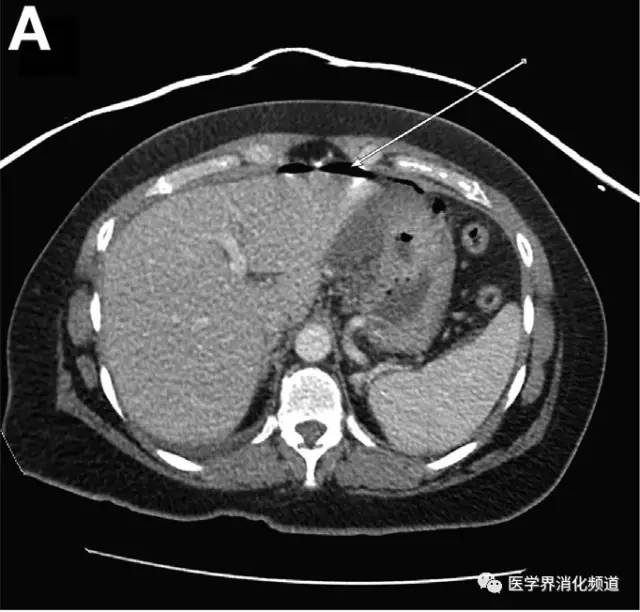 【病例】胃癌伴卵巢Krukenberg瘤1例CT 【病例】胃癌伴卵巢Krukenberg瘤1例CT