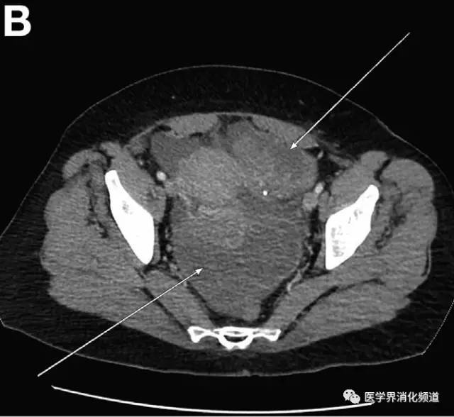 【病例】胃癌伴卵巢Krukenberg瘤1例CT