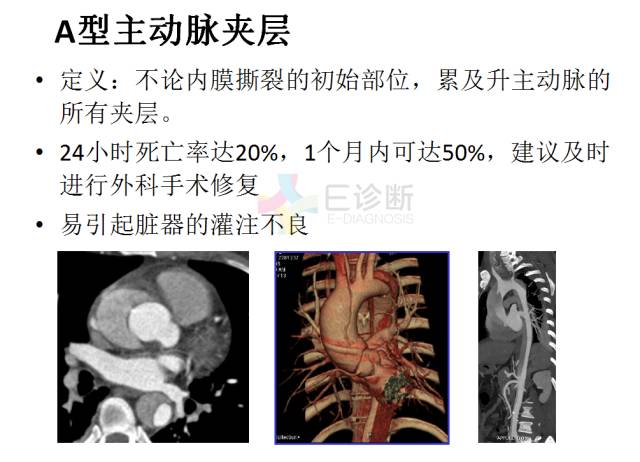 【PPT】急性主动脉综合征CTA诊断及高风险征象评估