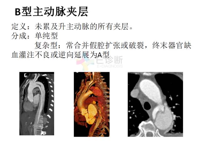 【PPT】急性主动脉综合征CTA诊断及高风险征象评估