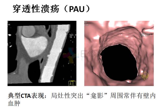 【PPT】急性主动脉综合征CTA诊断及高风险征象评估