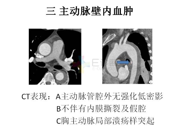 【PPT】急性主动脉综合征CTA诊断及高风险征象评估