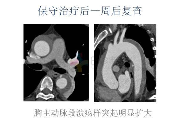 【PPT】急性主动脉综合征CTA诊断及高风险征象评估