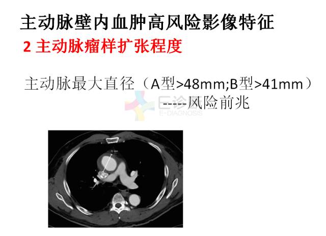 【PPT】急性主动脉综合征CTA诊断及高风险征象评估