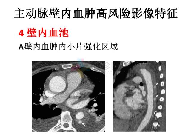 【PPT】急性主动脉综合征CTA诊断及高风险征象评估