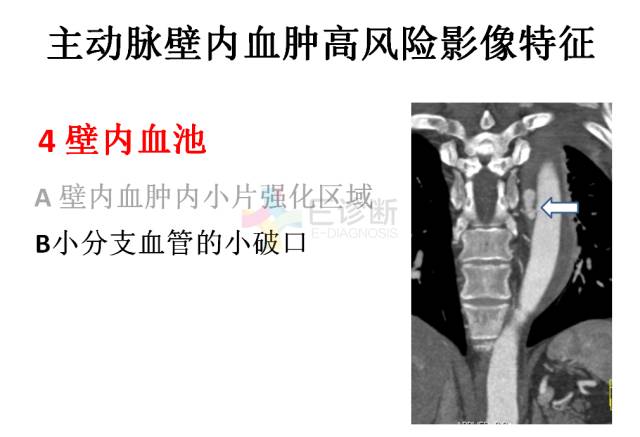【PPT】急性主动脉综合征CTA诊断及高风险征象评估