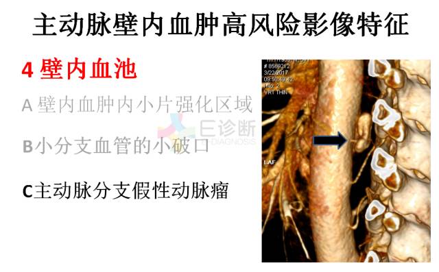 【PPT】急性主动脉综合征CTA诊断及高风险征象评估