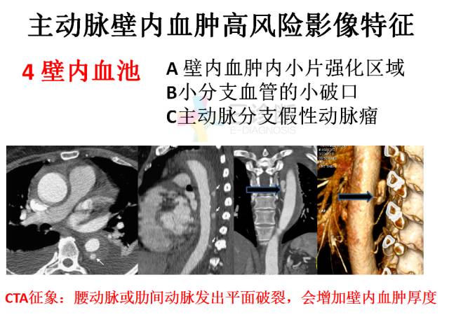 【PPT】急性主动脉综合征CTA诊断及高风险征象评估