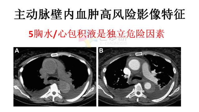 【PPT】急性主动脉综合征CTA诊断及高风险征象评估