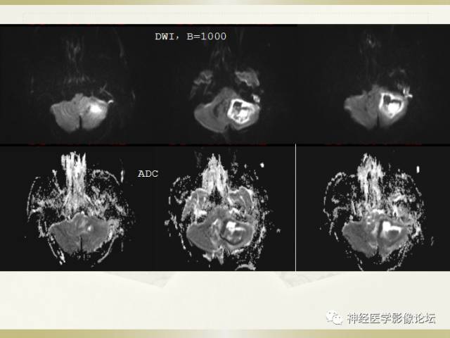 【病例】小脑脓肿一例 CT及MR