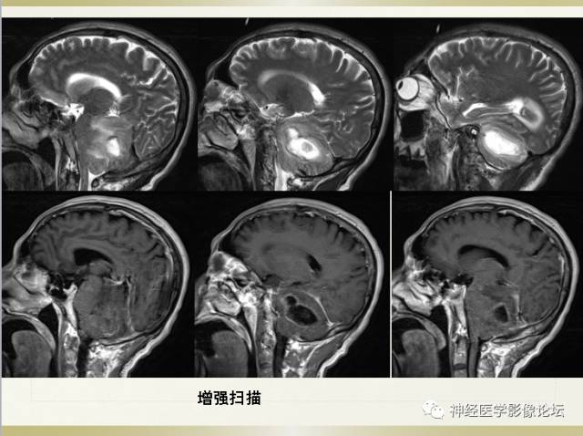 【病例】小脑脓肿一例 CT及MR