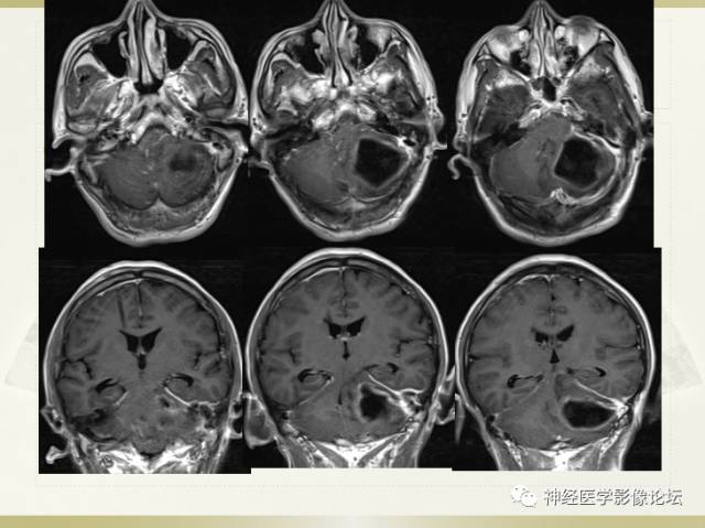 【病例】小脑脓肿一例 CT及MR