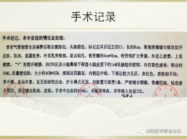 【病例】小脑脓肿一例 CT及MR
