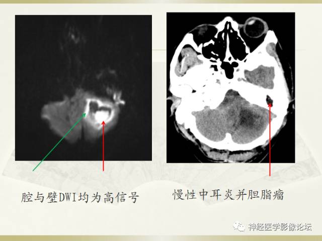 【病例】小脑脓肿一例 CT及MR
