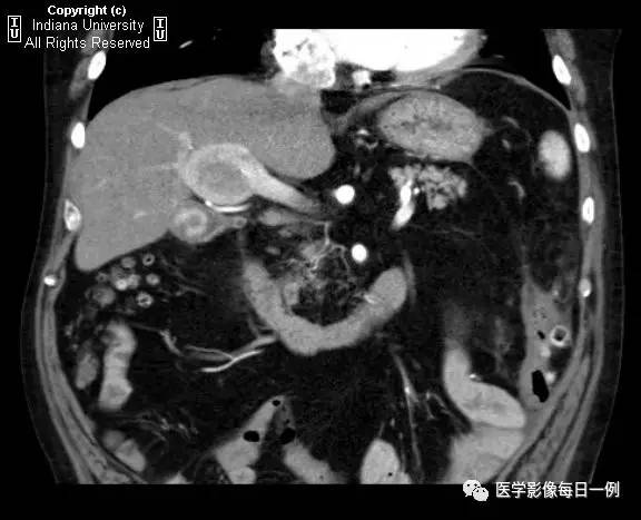 【病例】门静脉瘤并动静脉瘘1例CT