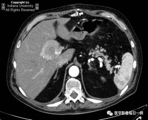 【病例】门静脉瘤并动静脉瘘1例CT