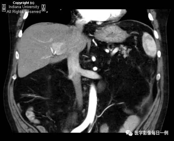 【病例】门静脉瘤并动静脉瘘1例CT