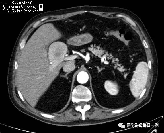 【病例】门静脉瘤并动静脉瘘1例CT