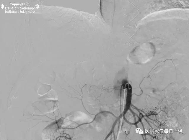 【病例】门静脉瘤并动静脉瘘1例CT