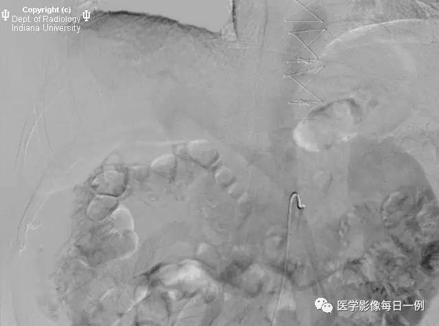 【病例】门静脉瘤并动静脉瘘1例CT