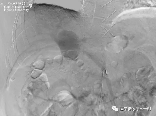 【病例】门静脉瘤并动静脉瘘1例CT
