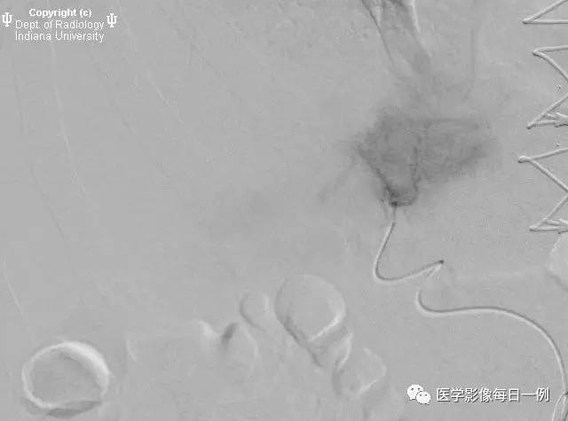 【病例】门静脉瘤并动静脉瘘1例CT