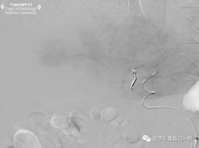 【病例】门静脉瘤并动静脉瘘1例CT