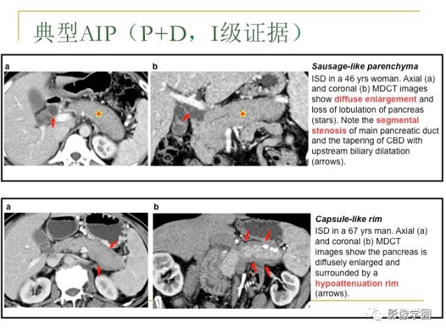【PPT】IgG4相关性系统性疾病——从自身免疫性胰腺炎说起