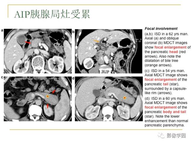 【PPT】IgG4相关性系统性疾病——从自身免疫性胰腺炎说起