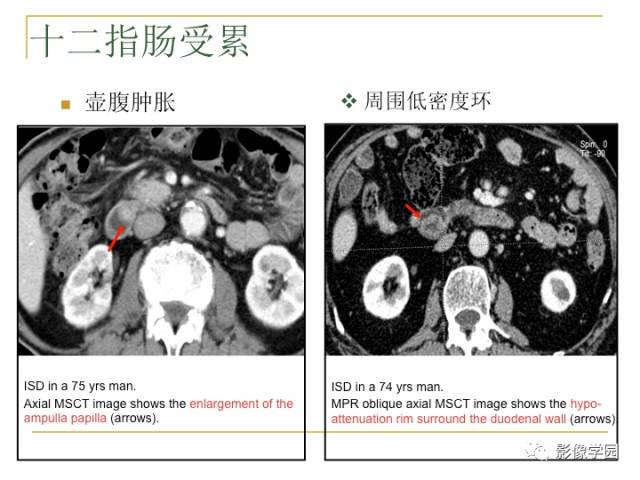 【PPT】IgG4相关性系统性疾病——从自身免疫性胰腺炎说起