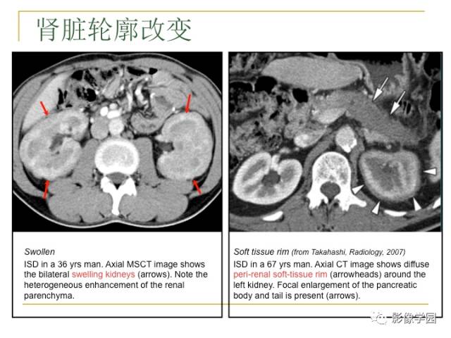 【PPT】IgG4相关性系统性疾病——从自身免疫性胰腺炎说起