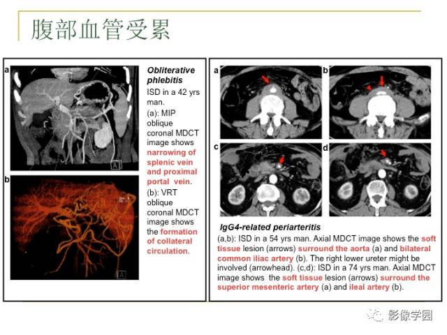 【PPT】IgG4相关性系统性疾病——从自身免疫性胰腺炎说起