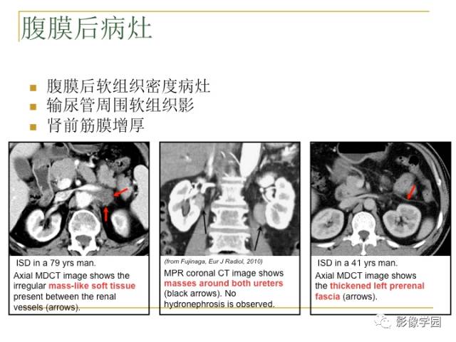 【PPT】IgG4相关性系统性疾病——从自身免疫性胰腺炎说起