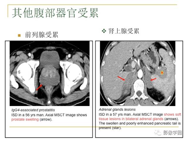 【PPT】IgG4相关性系统性疾病——从自身免疫性胰腺炎说起