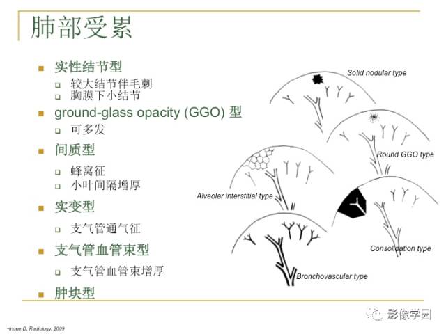 【PPT】IgG4相关性系统性疾病——从自身免疫性胰腺炎说起
