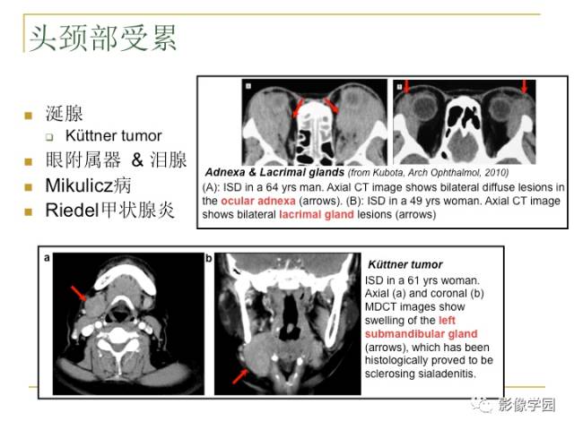 【PPT】IgG4相关性系统性疾病——从自身免疫性胰腺炎说起